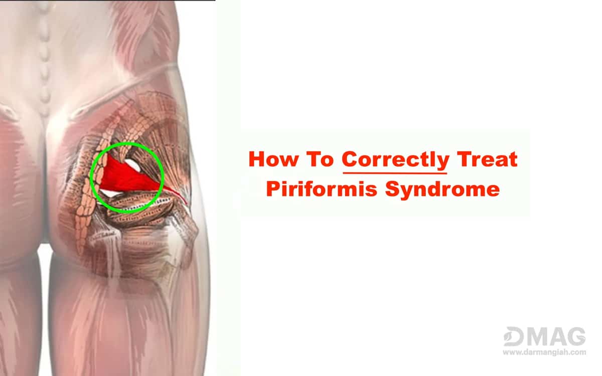 Piriformis Syndrome