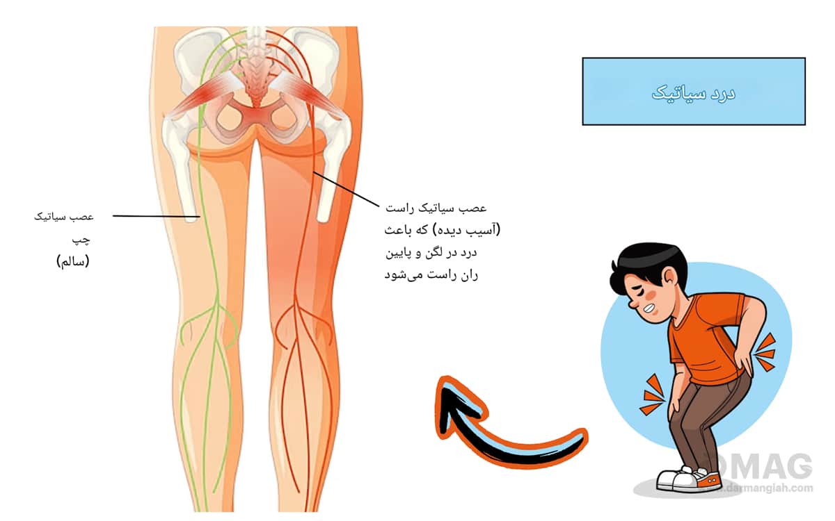 علت سیاتیک چیست