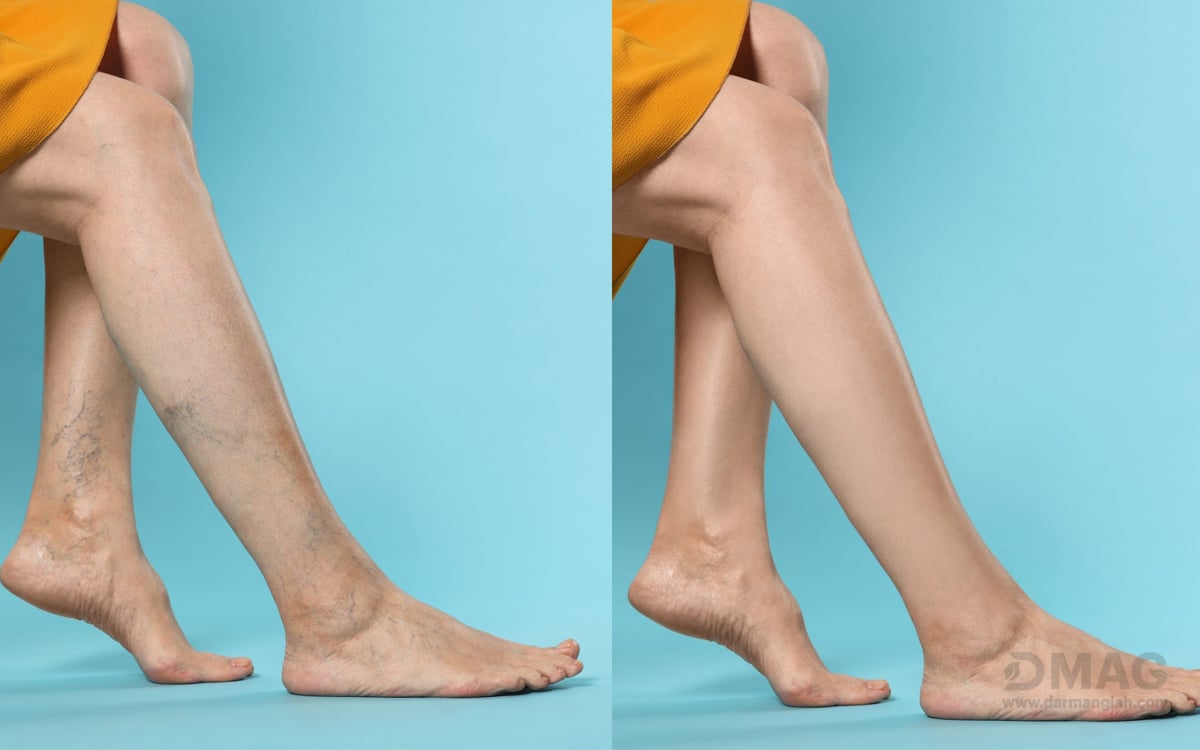 درمان واریس با حجامت