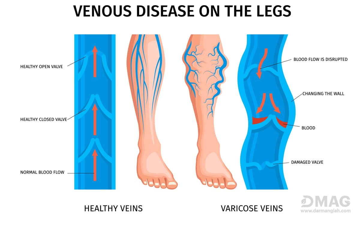 درمان واریس با حجامت