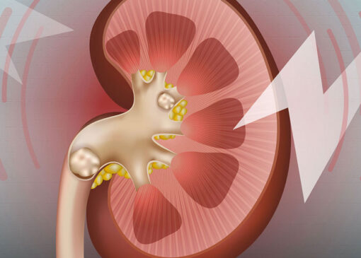 سنگ کلیه در بارداری