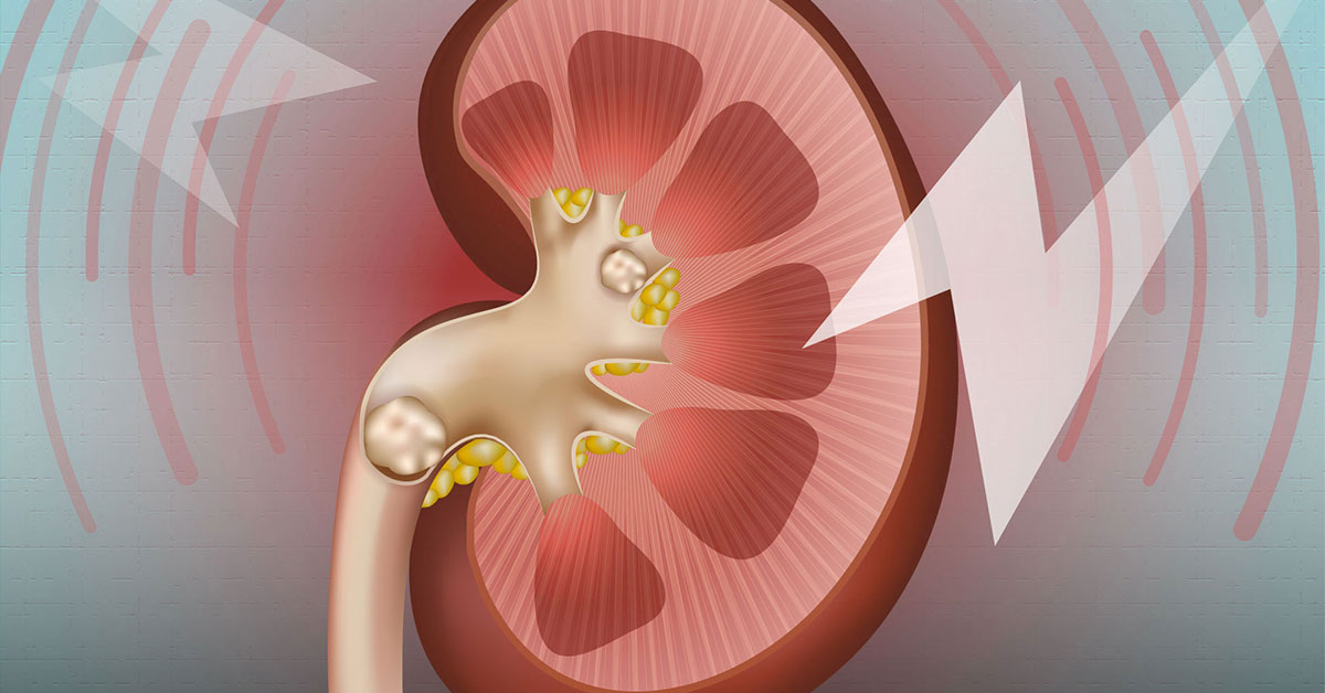 سنگ کلیه در بارداری