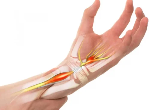 تنگی تونل کارپال