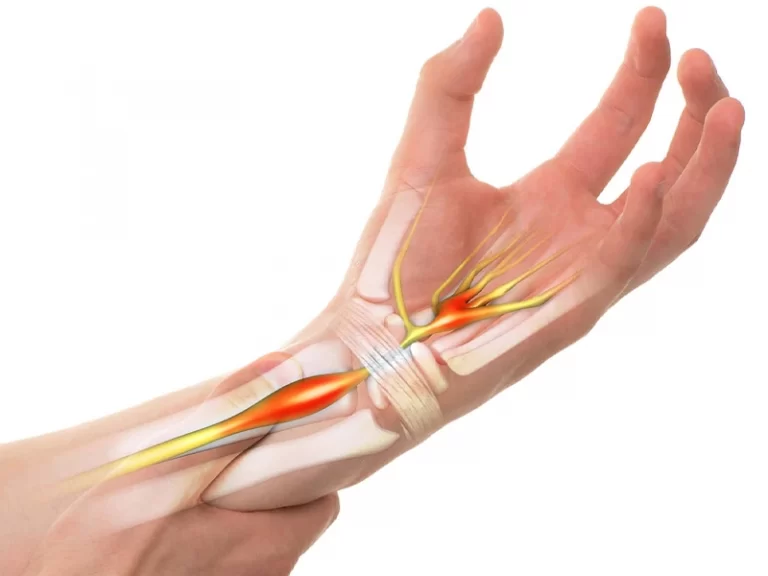 تنگی تونل کارپال