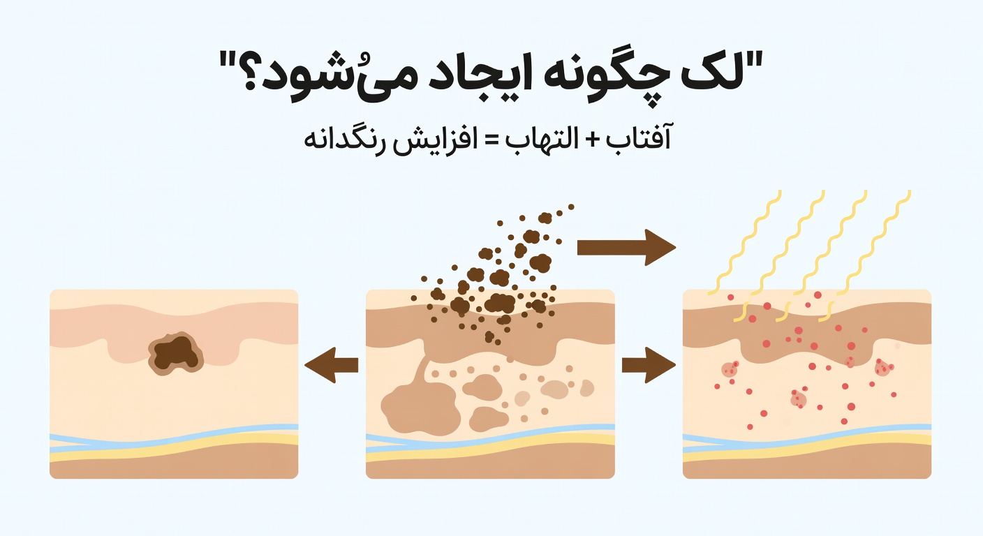 پروسه به وجود آمدن لک های پوستی