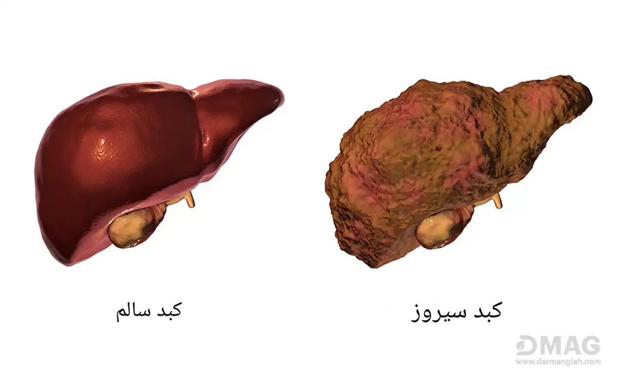 درمان گیاهی سیروز کبدی