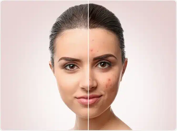 بهترین روش رفع جوش صورت
