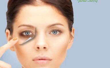 تیرگی دور چشم e1684443576386