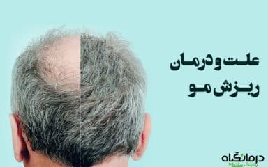 درمان ریزش مو سکه ای مردان و زنان
