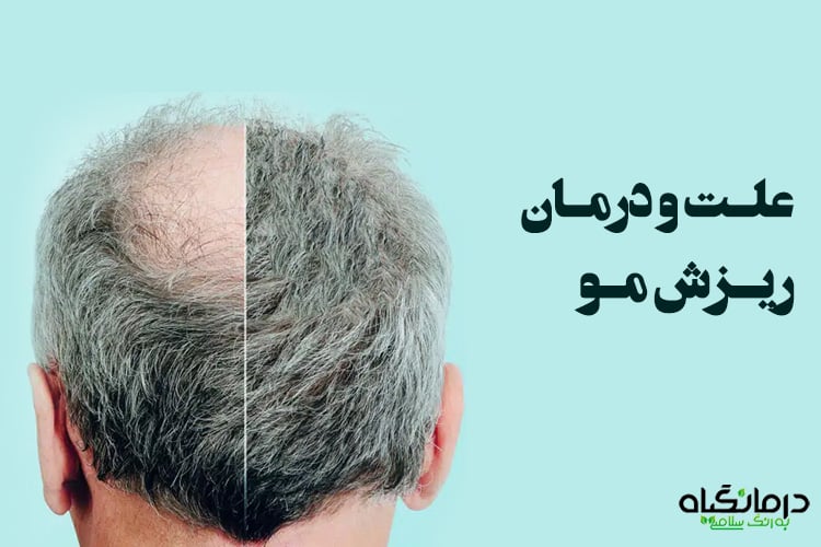 درمان ریزش مو سکه ای مردان و زنان
