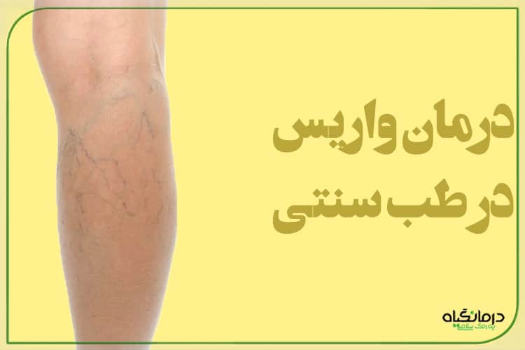 درمان واریس در طب سنتی