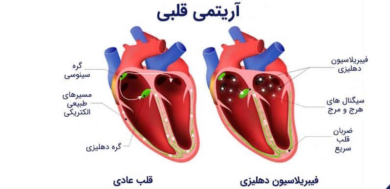 قرص آریتمی قلب